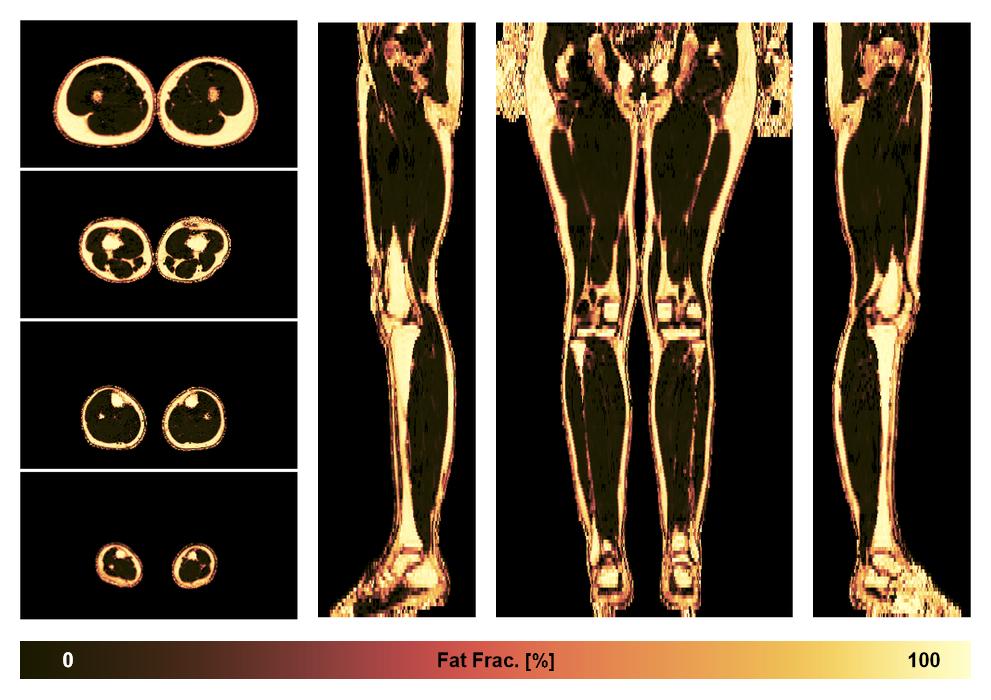 The fat fraction of the lower extremity obtained from the dixon reconstruction for muscle water fat quantification.